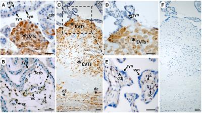 Preeclampsia is Associated With Reduced ISG15 Levels Impairing Extravillous Trophoblast Invasion